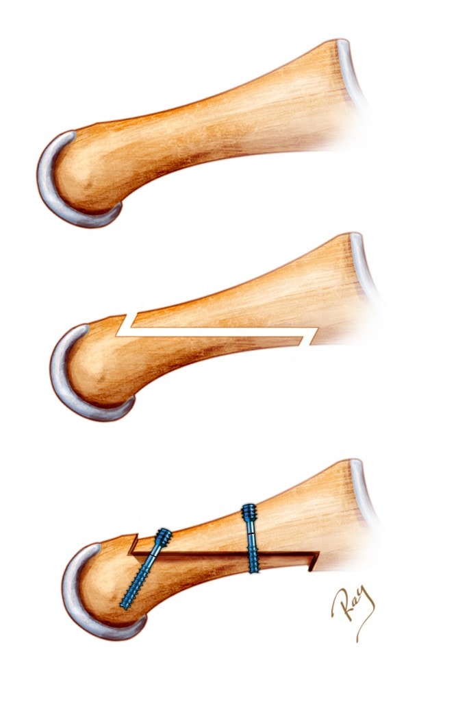 osteotomie de Scarf dans l'hallux valgus