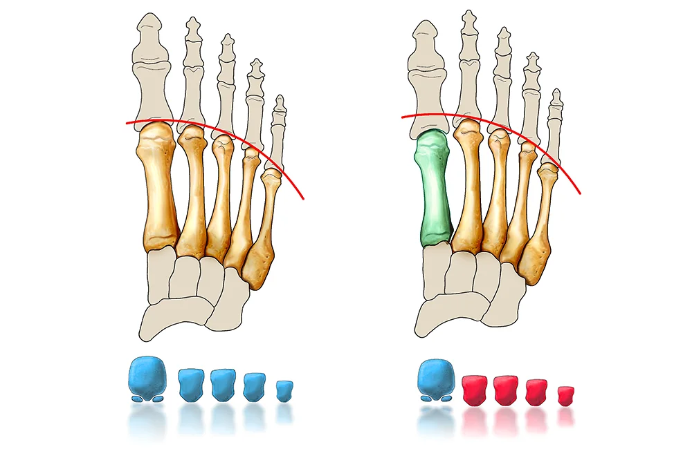 Metatarsalgies explication