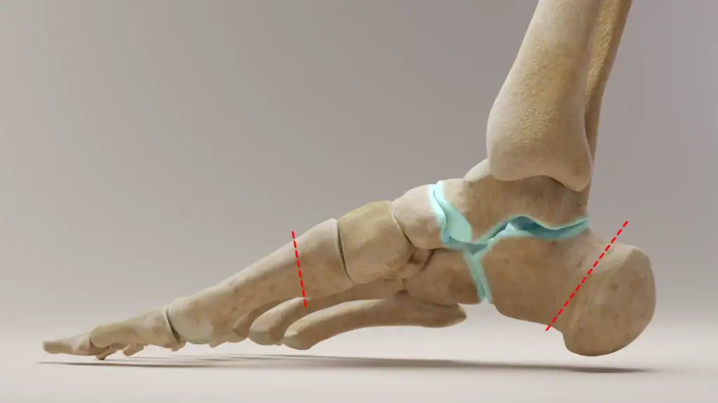 illustration montrant les zones d'ostéotomies et d'arthrodèse dans la correction du pied creux