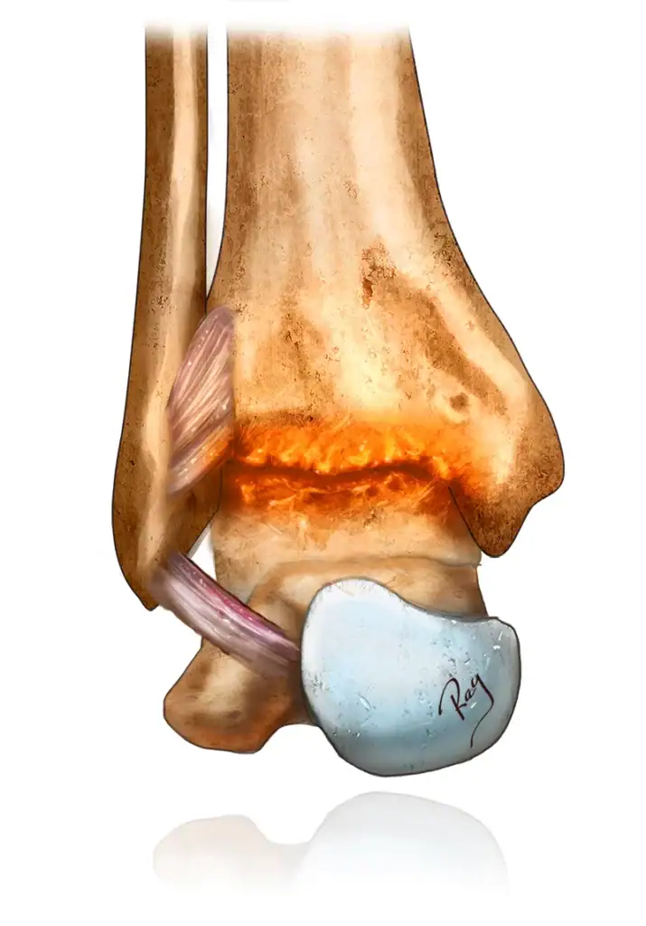 Illustration d'une arthrose de cheville