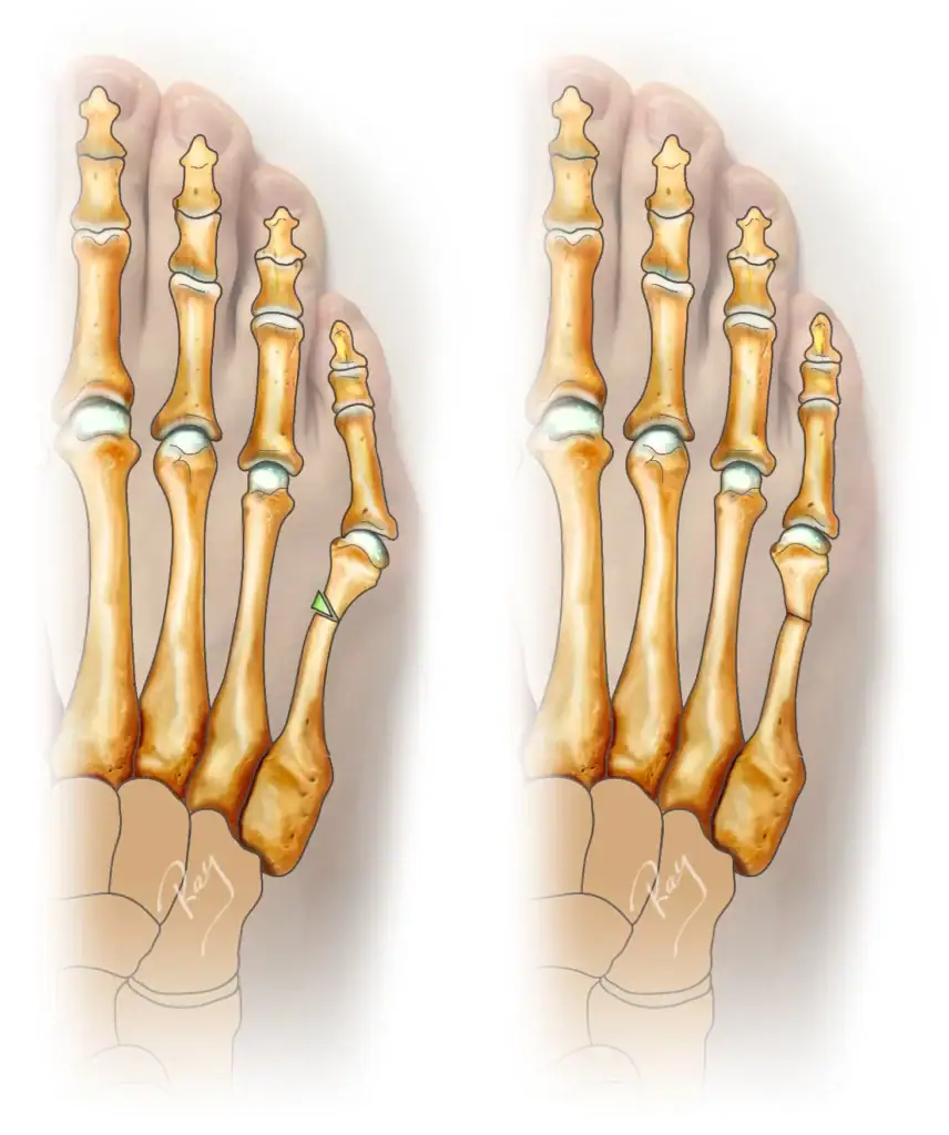 chirurgie de correction d'un quintus varus ou bunionette