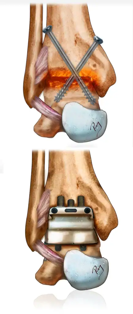 Illustration d'une arthrodèse et d'une prothèse de cheville