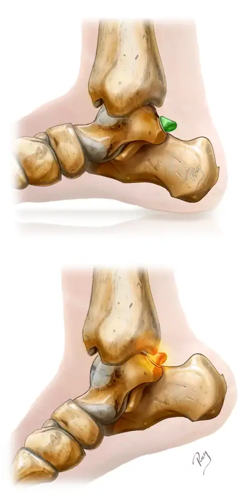 Illustration d'conflit postérieur de cheville avec os trigone