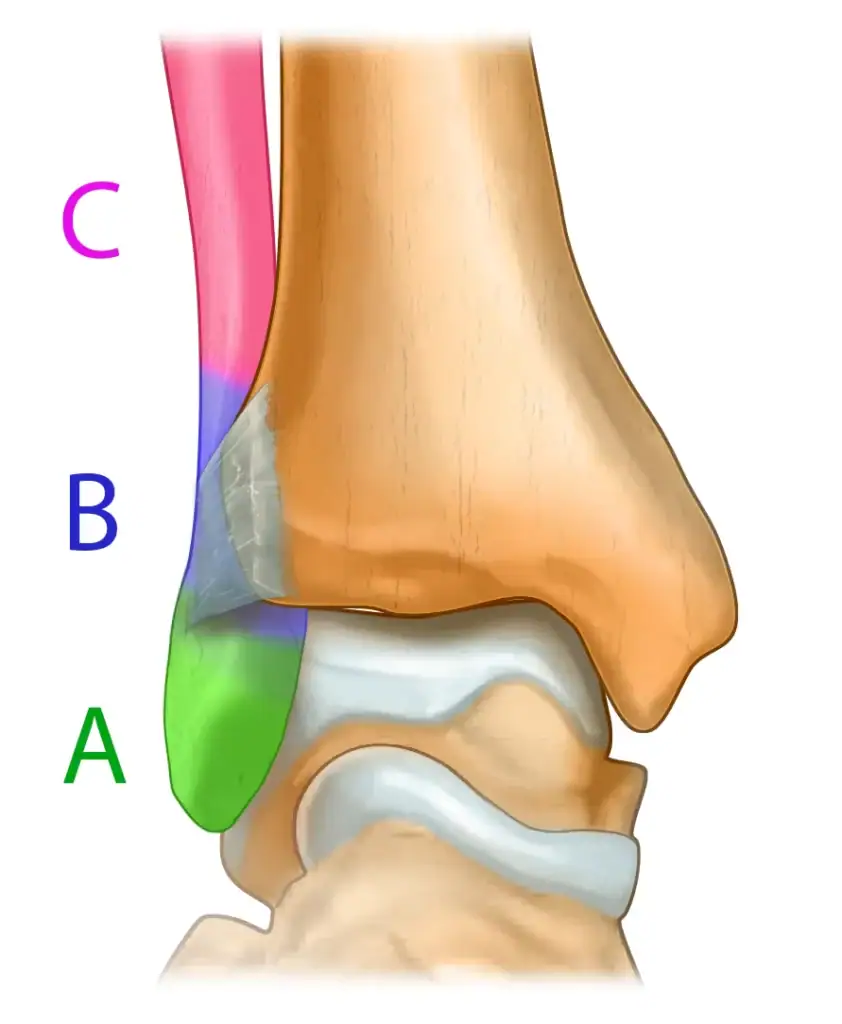 Illustration de la classification de Danis-Weber pour les fractures de cheville