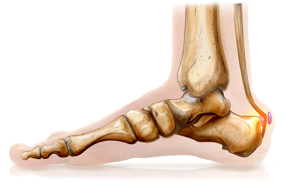 Schéma d'une déformation de Haglund entraînant un conflit entre le calcanéum et le tendon d'Achille