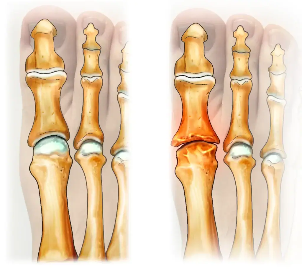 illustration d'un hallux rigidus