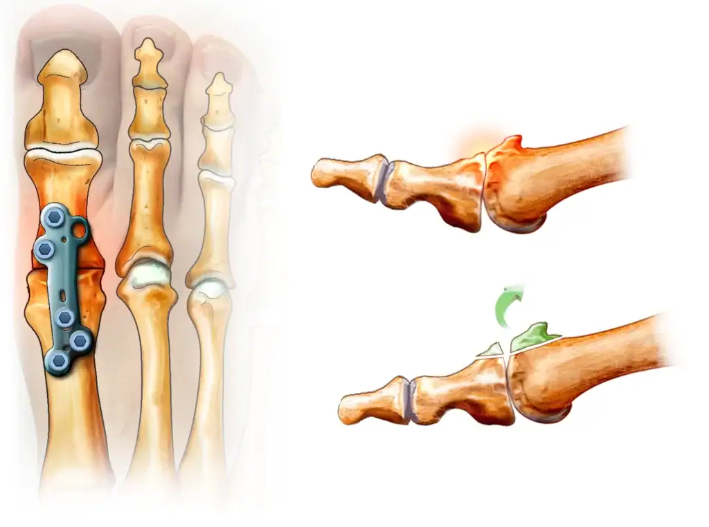 chirurgie de l'hallux rigidus par arthrodèse et cheilectomie