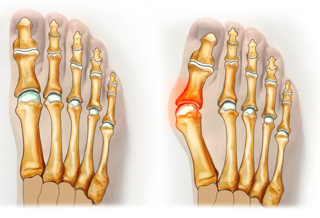 Illustration d'un hallux valgus et d'un hallux normal