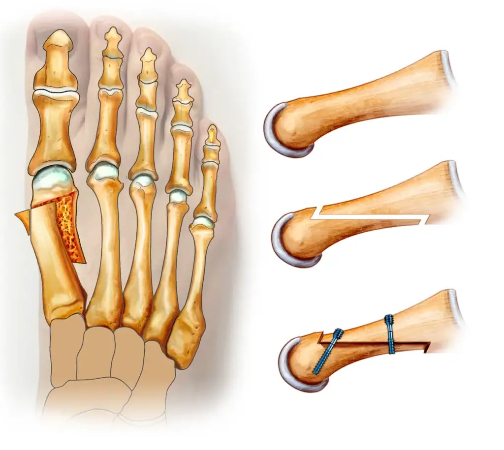 correction d'hallux valgus par ostéotomie de Scarf