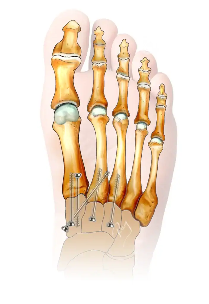 Illustration d'une arthrodèse du Lisfranc
