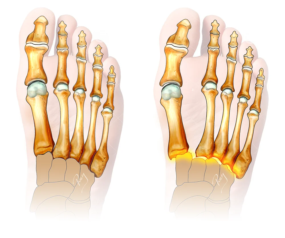 Illustration d'une luxation du Lisfranc