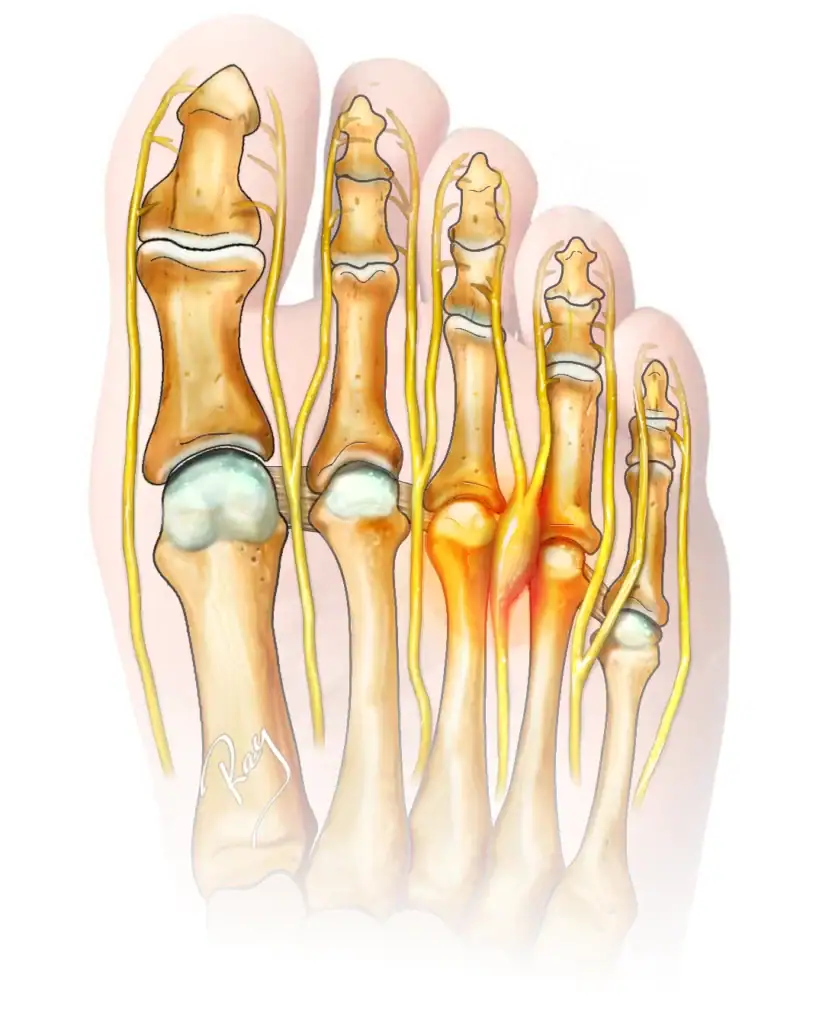 illustration anatomie d'un névrome de Morton entre les métatarsiens