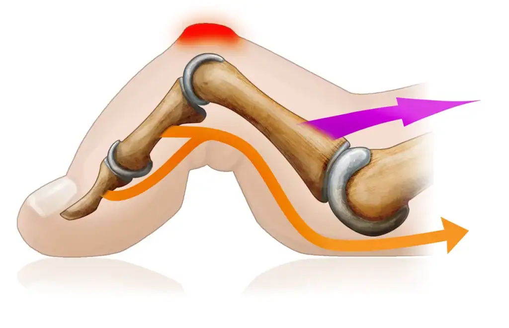 illustration d'un orteil en griffe et de son anatomie