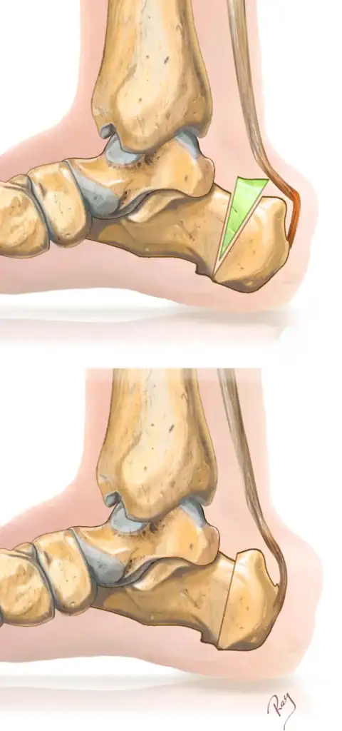 Osteotomie de Zadek