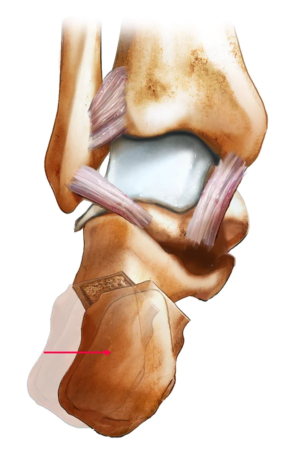 Illustration d'une correction de pied plat par ostéotomie de varisation du calcanéum