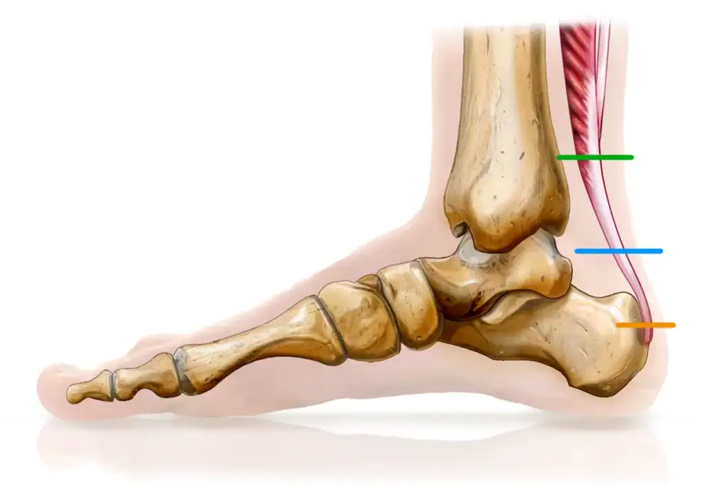 Rupture tendon achille schema hauteurs