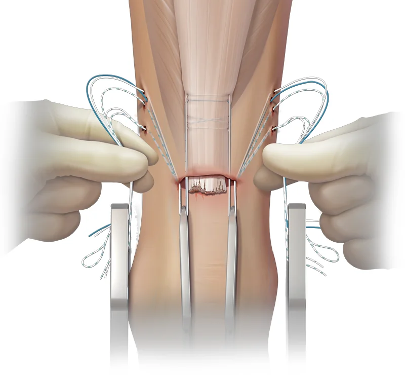 Système de suture du tendon d'Achille micro-invasif PARS