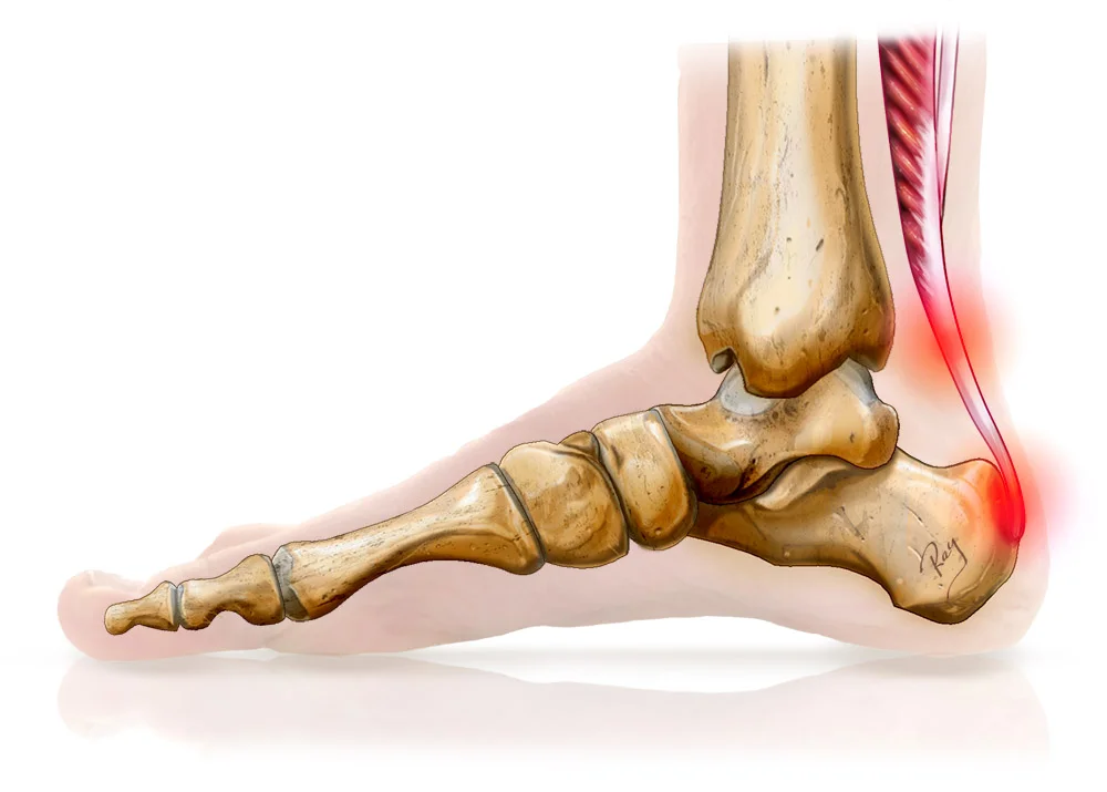 Schéma des tendinopathies insertionnelles et non-insertionnelles d'Achille