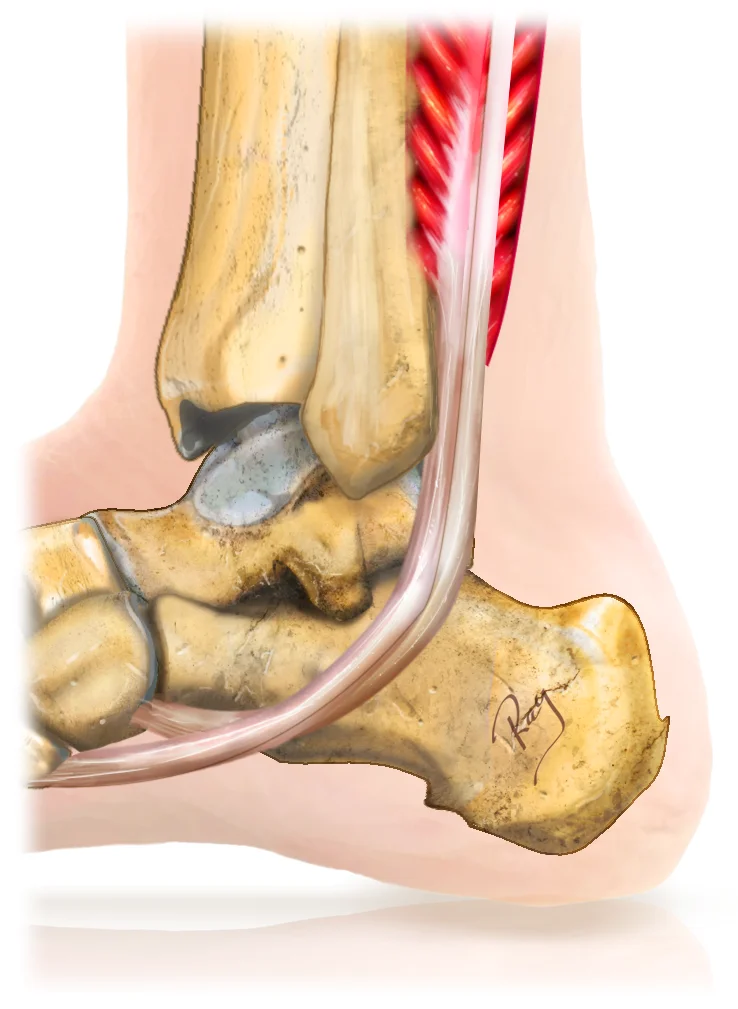 illustration de l'anatomie des tendons péroniers au niveau de la cheville